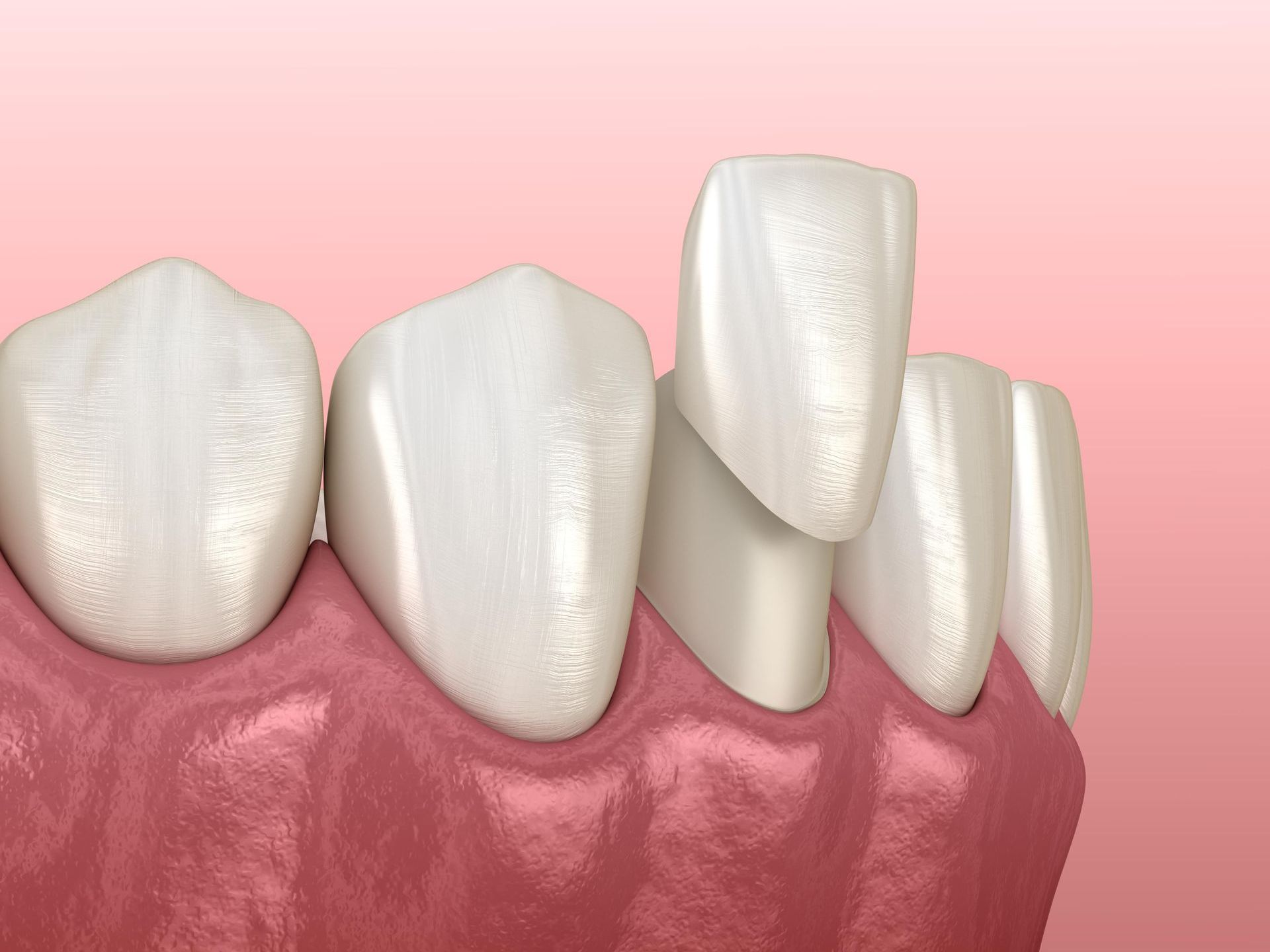 A computer generated image of a porcelain veneer on a tooth