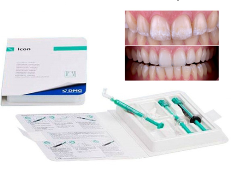 Effective Treatment For White Spots: Icon Smooth Surface : Live & Smile Dental & Orthodontics