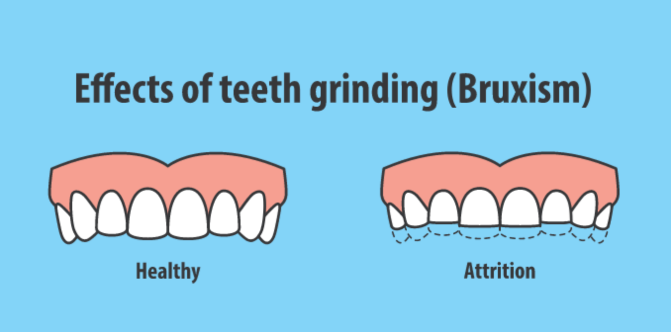 Teeth Grinding : Live & Smile Dental & Orthodontics