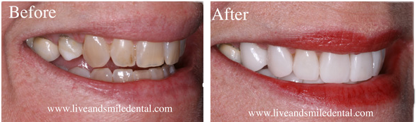 a before and after photo of a woman 's teeth .