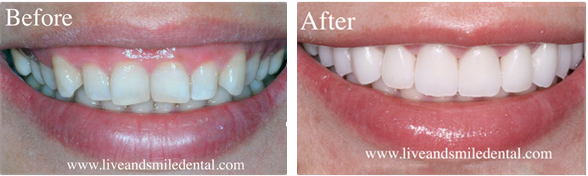 a before and after photo of a woman 's teeth