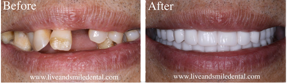a before and after picture of a person 's teeth .
