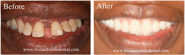 a before and after photo of a person 's teeth .