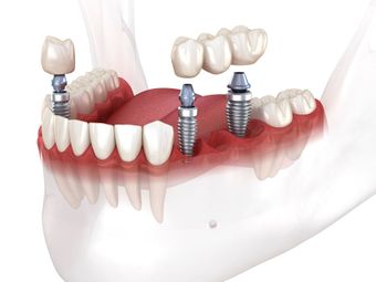 Dental Implants