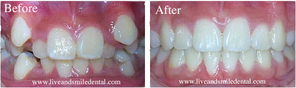 a before and after picture of a person 's teeth .