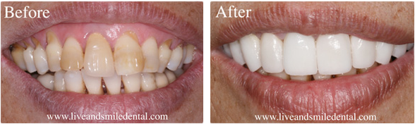 a before and after photo of a person 's teeth .