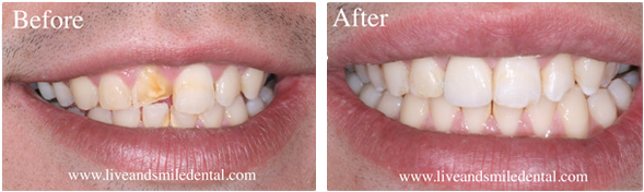 Teeth Whitening Revitalize Your Smile In Dublin Ca And Alameda County