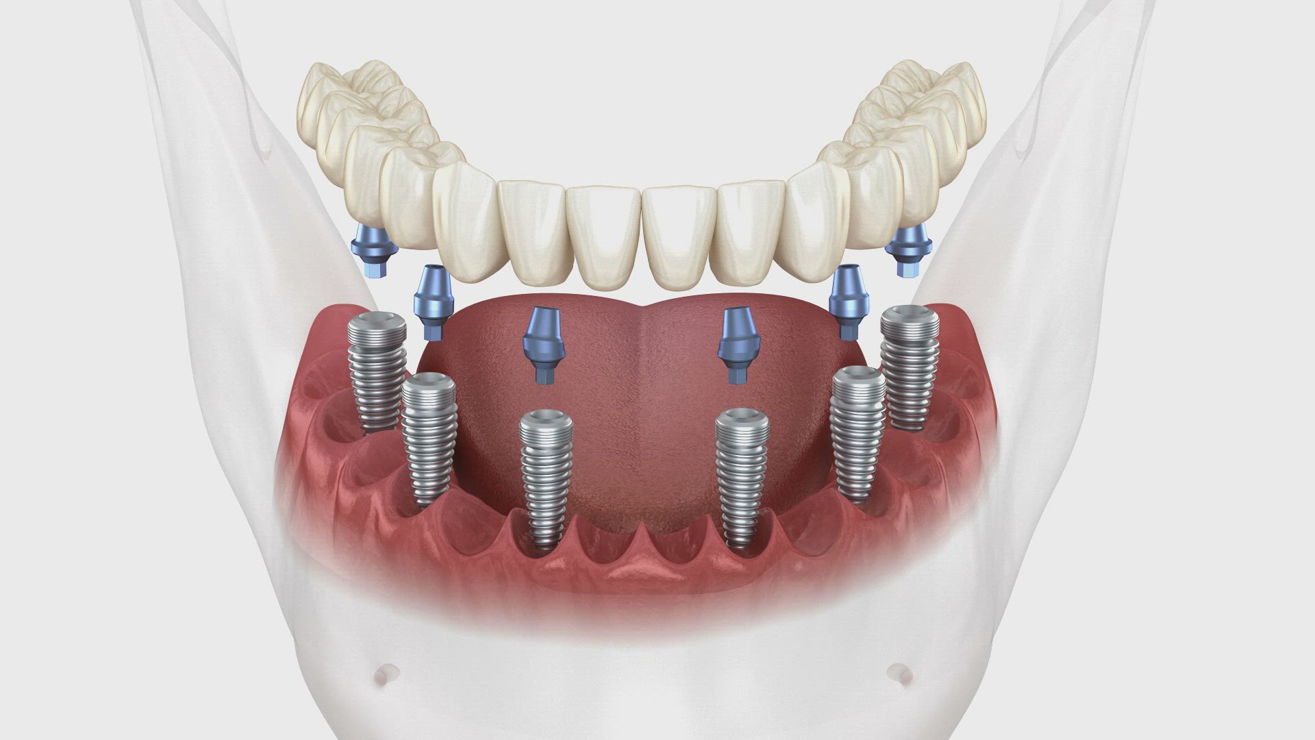 Имплантация зубов all on 6. Имплантация зубов на 6 имплантах. Балочная система на 6 имплантатах.