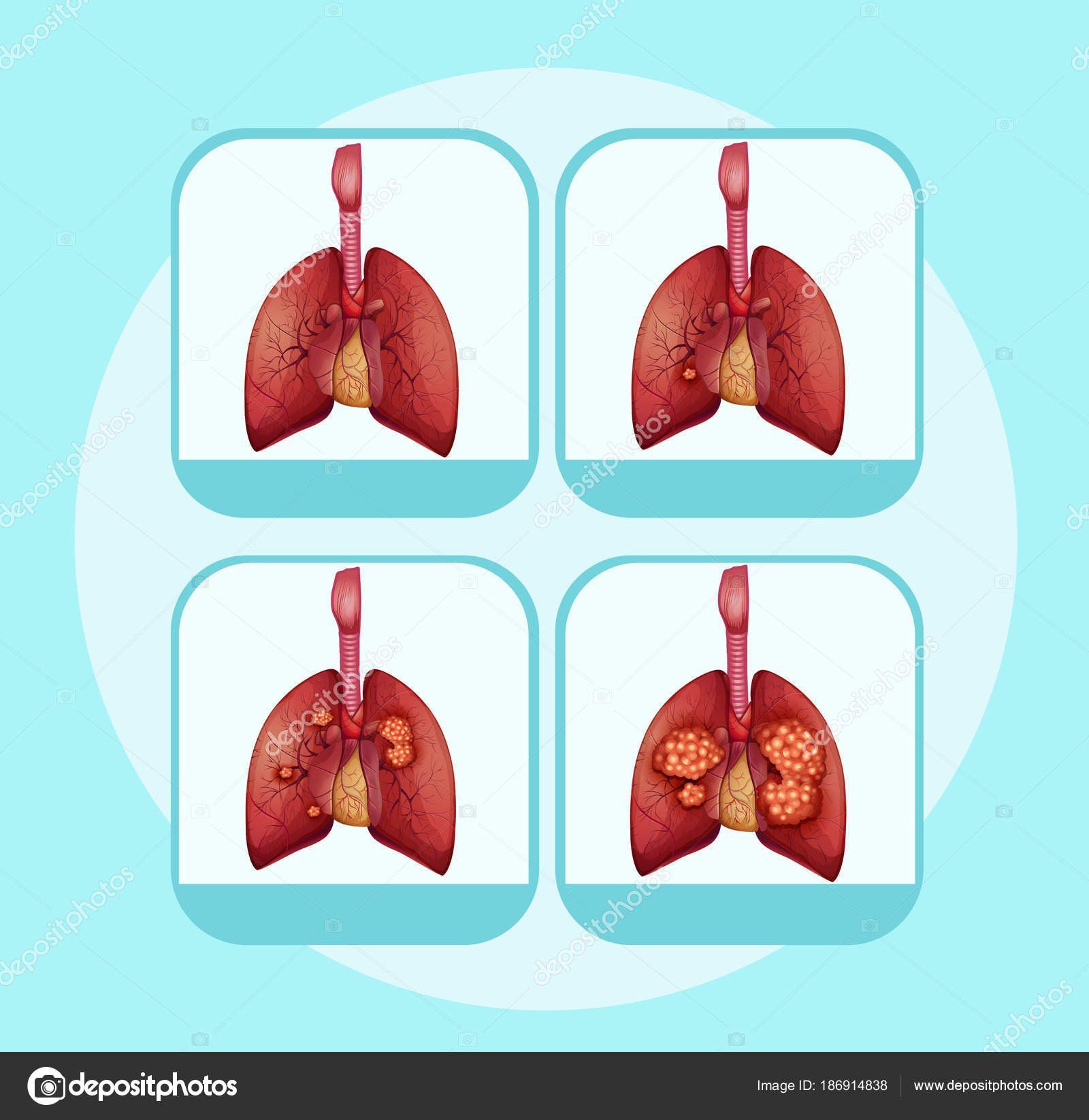 Gli stadi del tumore polmonare da I a IV
