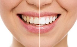Teeth Whitening — Richardson, TX — Mark L. Ethridge, DDS