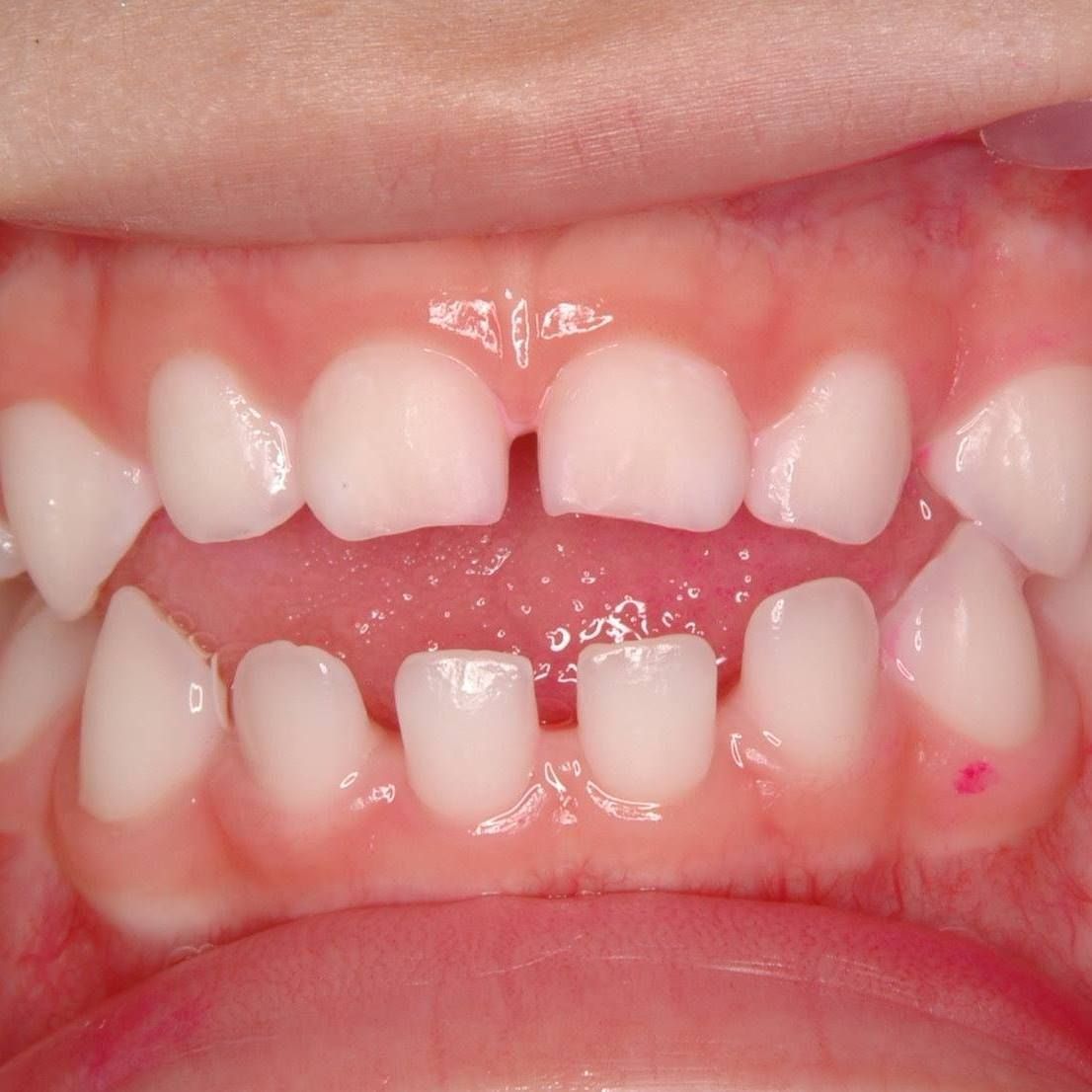 Close-up of a child's mouth showing developing teeth; a gap between the front teeth is visible.