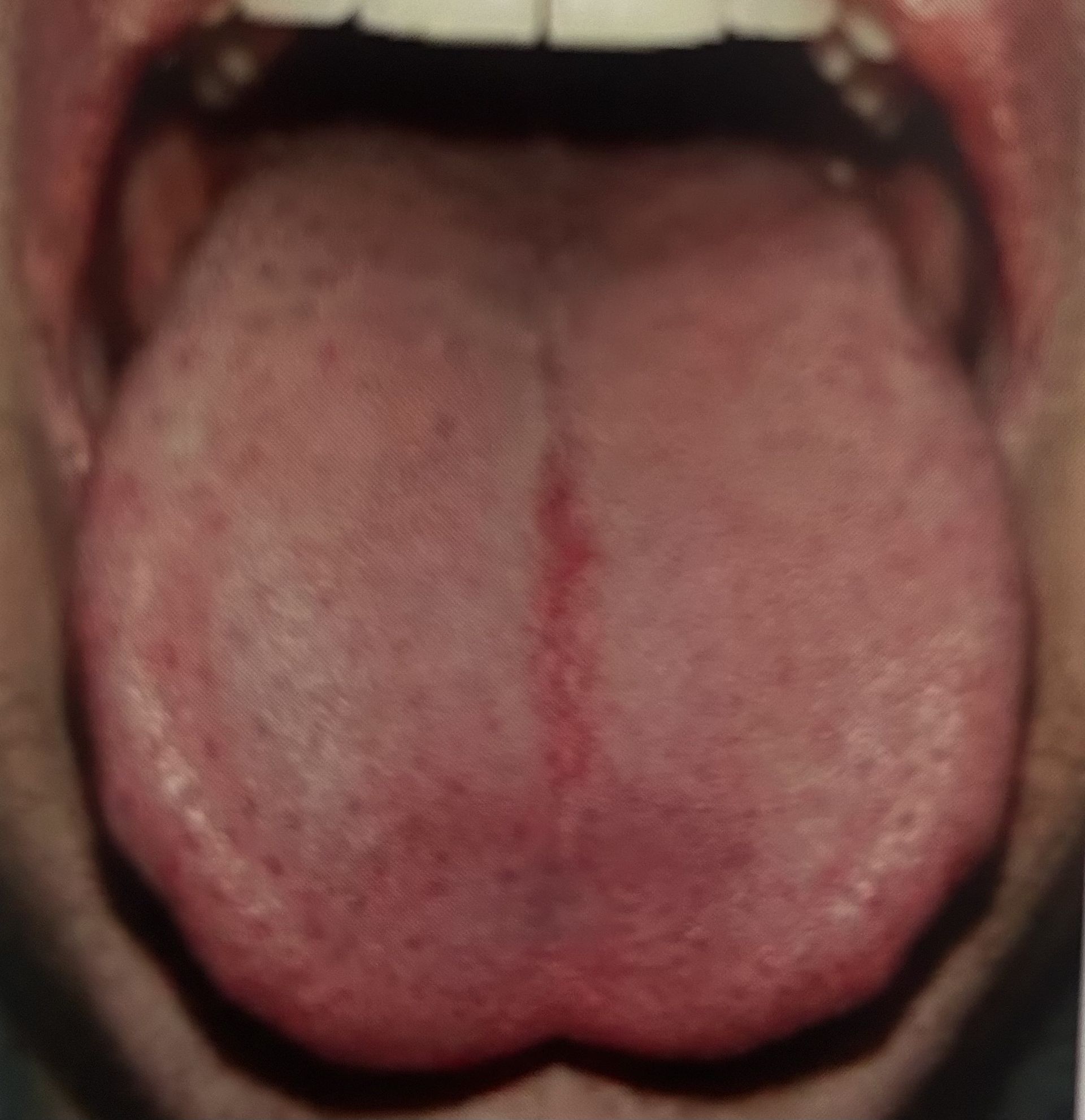 Close-up of a person's tongue. The tongue is pink with a red vertical line and small red dots.