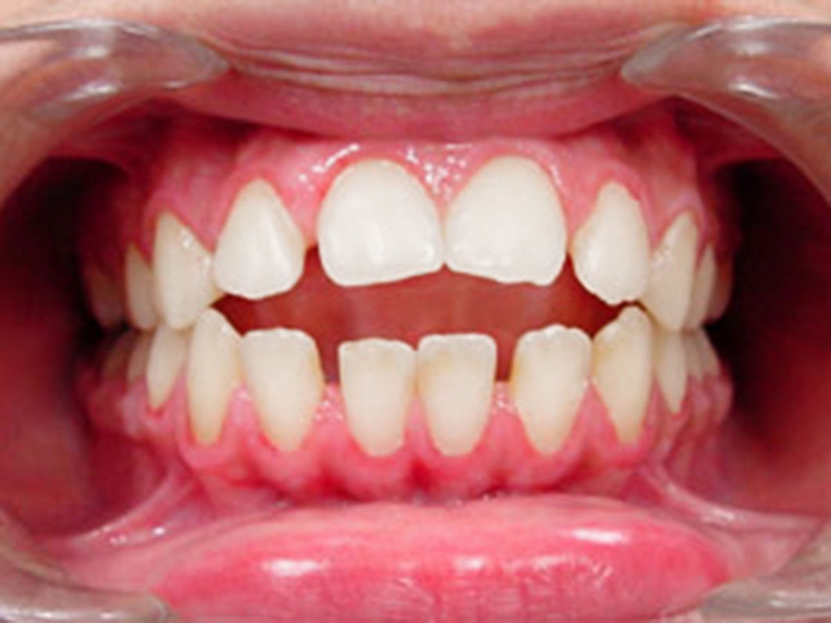 Open mouth with visible upper and lower teeth; uneven spacing and gaps present.