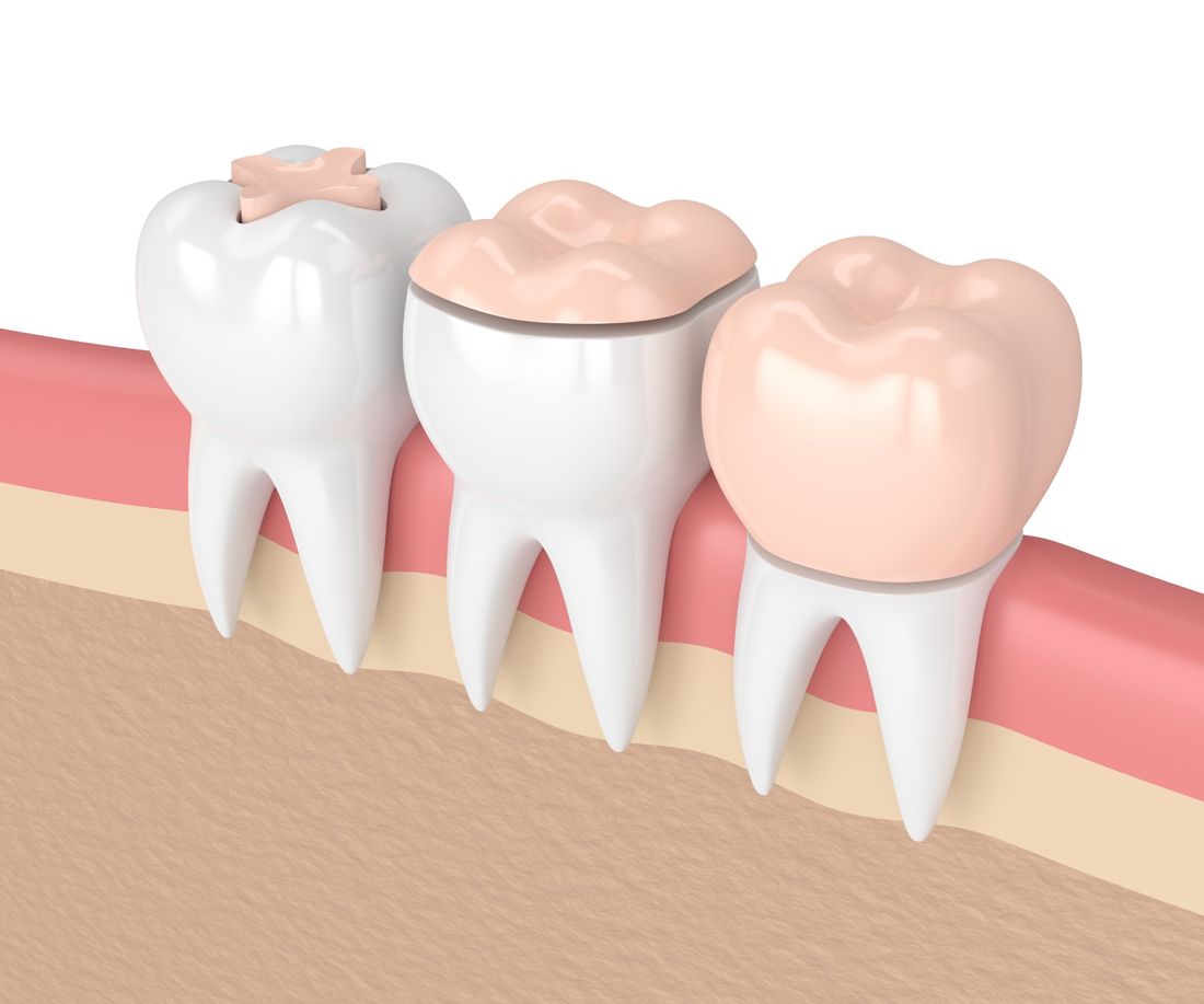 figura che mostra la ricostruzione dentale