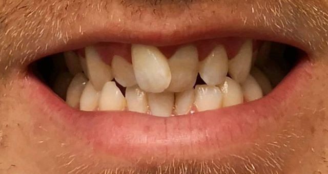 Before and after- Smile On Us Dental