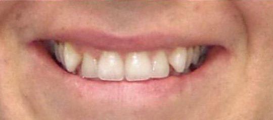 Before and after- Smile On Us Dental