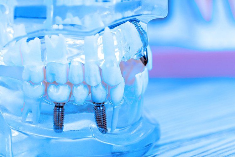 Dental Implants Hollywood FL 33020