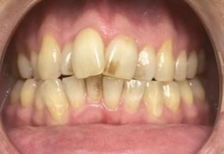Before and after- Smile On Us Dental