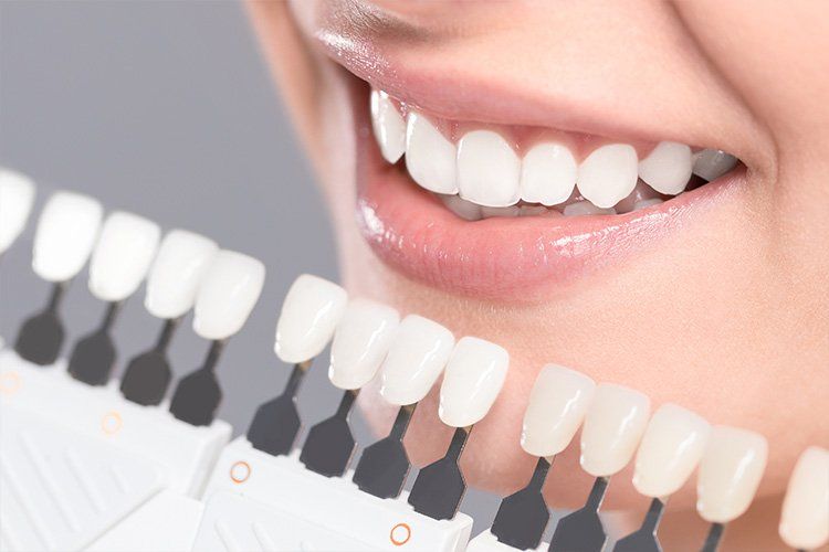 Close up of woman smiling in front of teeth shade guide