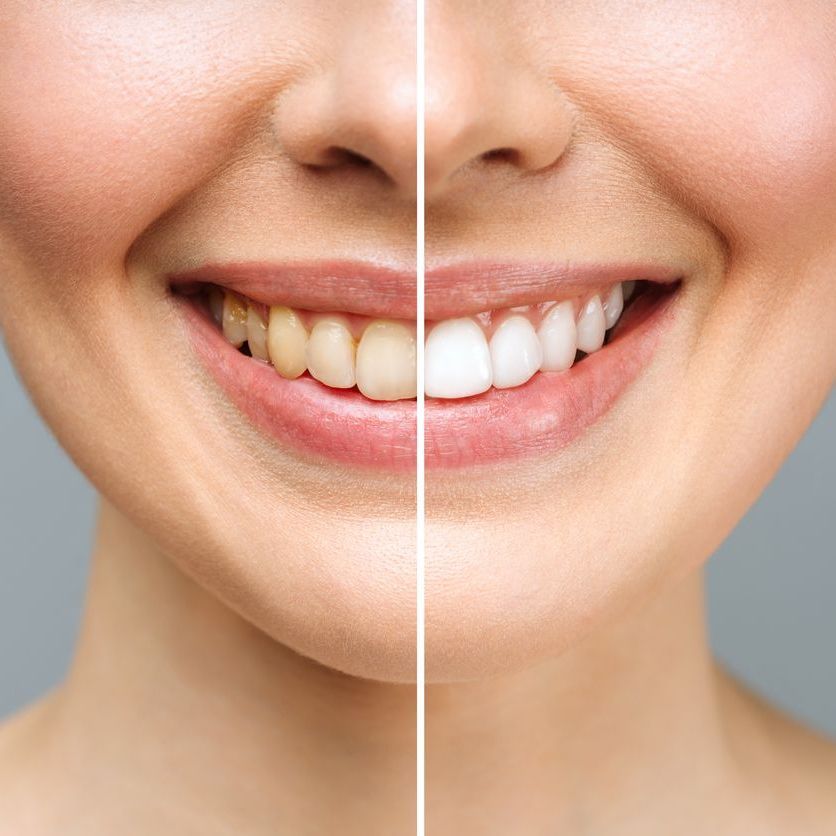 A woman 's smile before and after whitening her teeth.