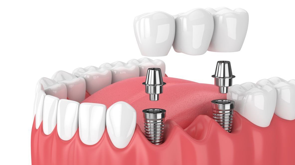 A 3d rendering of a dental implant being placed in a person 's mouth.