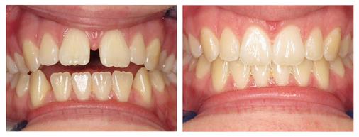 Before and after- Smile On Us Dental