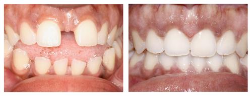 Invisalign before and after shots