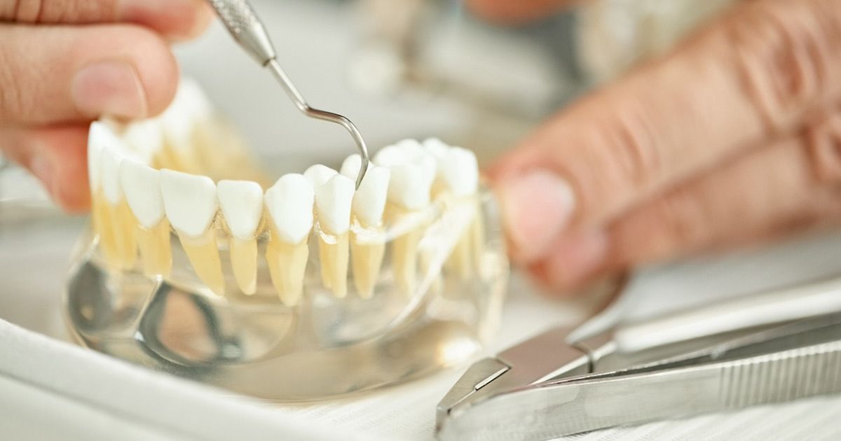 dental implants and bridges