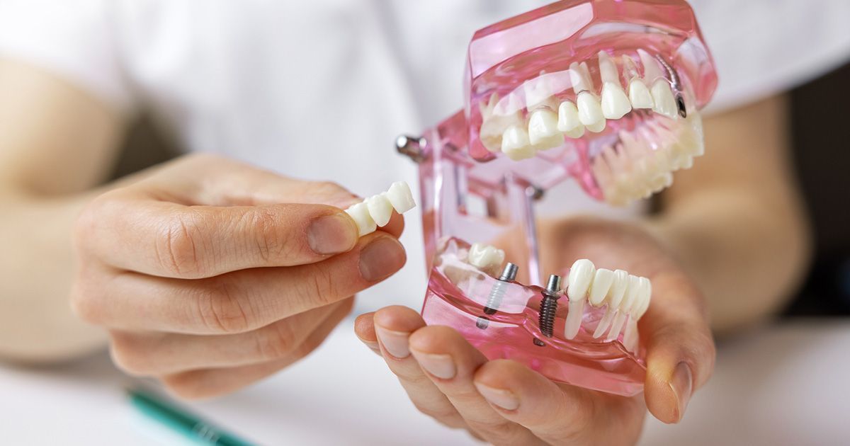 dental bridges vs implants