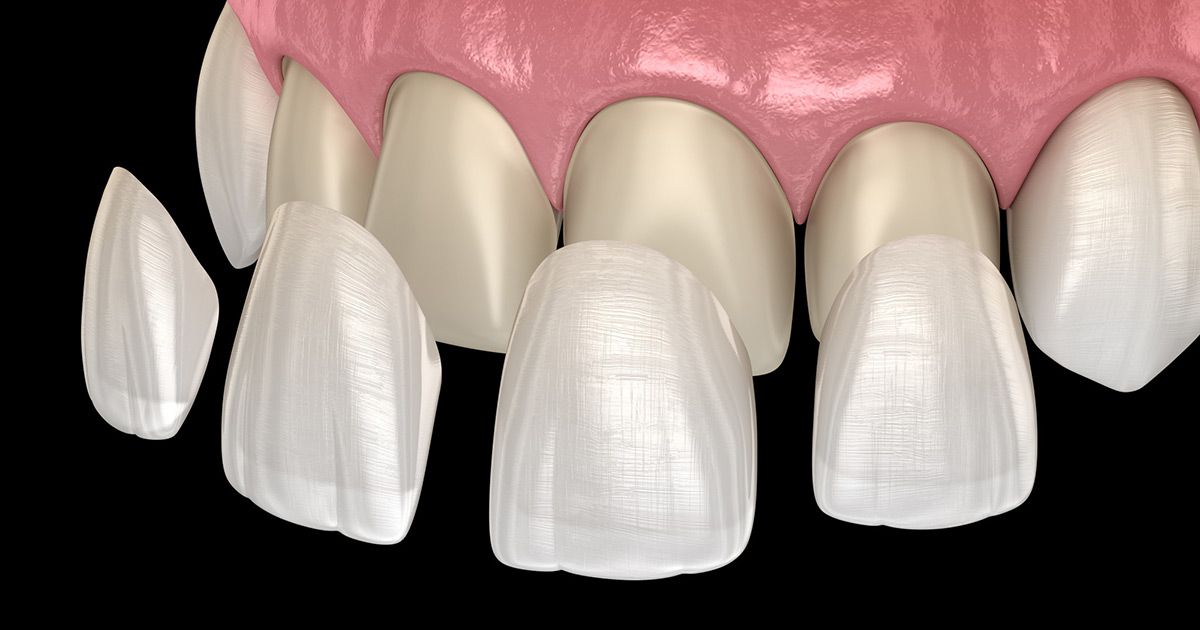 dental veneers, dentist in Hollywood FL