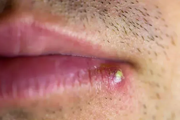 Close-up of a man's lips showing a small white spot on the upper lip, indicative of shingles.