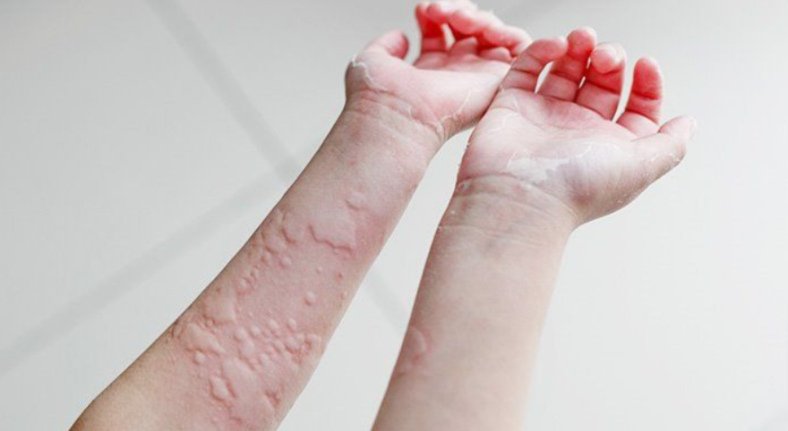 Common Causes of Hives
