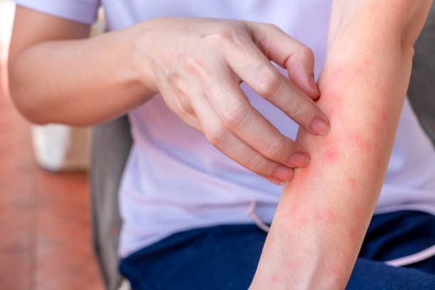 Learn when to seek urgent care for your rash. Get fast treatment for symptoms like itching, swelling