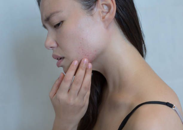 Symptoms of Hormonal Imbalance
