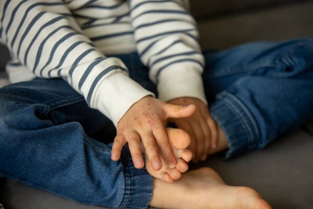 A kid with hand foot and mouth disease is scratching his feet.