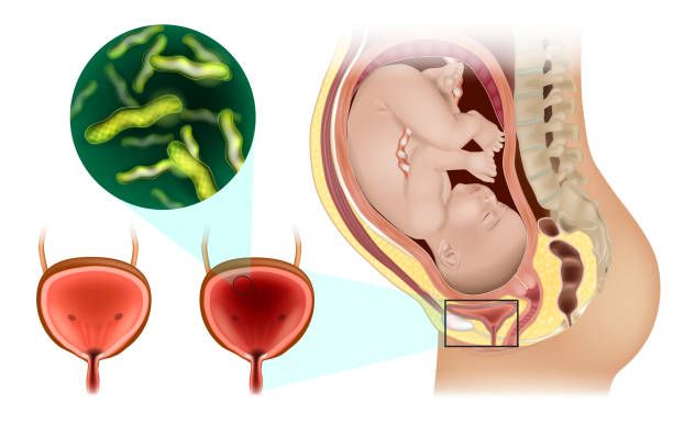 Why UTIs Are More Common in Pregnancy
