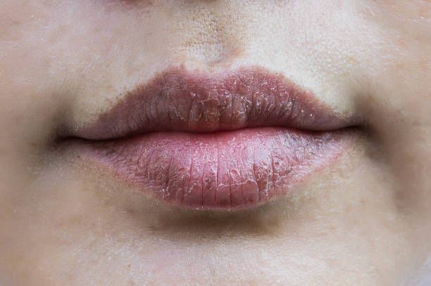 Signs You Might Be Dehydrated