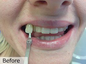 Before teeth whitening procedure