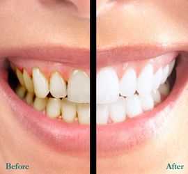 teeth whitening scarsdale, ny