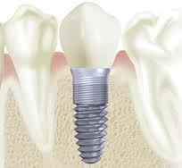 DENTAL IMPLANTS