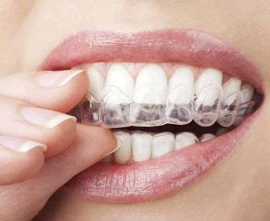 INVISALIGN
