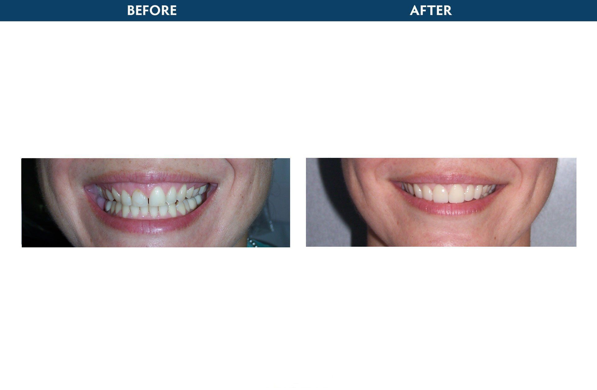 dental crowns elmsford, ny