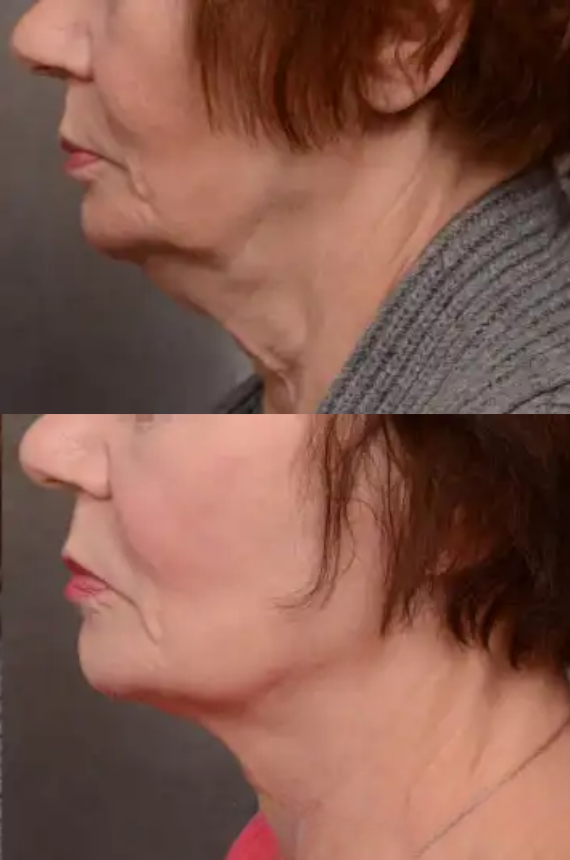 A woman is getting an Inmode Form Skin Tightening treatment on her thighs.