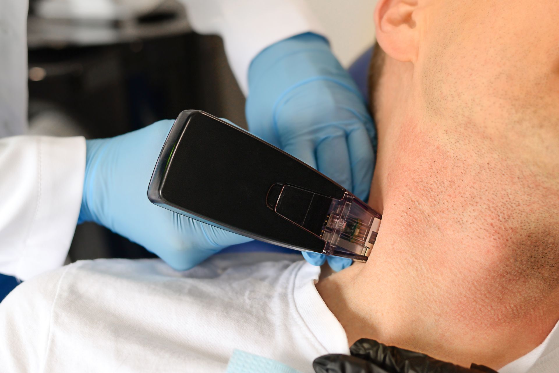 A practitioner in blue gloves uses a handheld laser device to treat the skin on a person's neck.