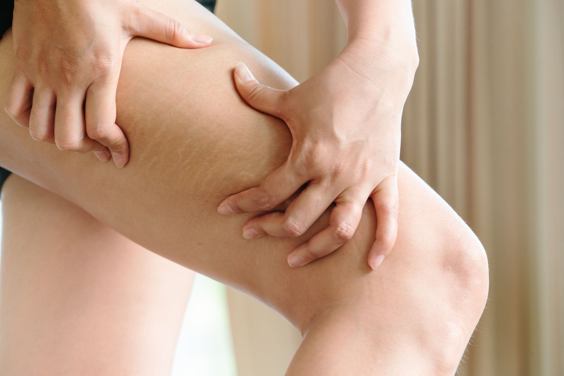 Person pinching skin on their thigh, showing dimpling that is characteristic of cellulite.