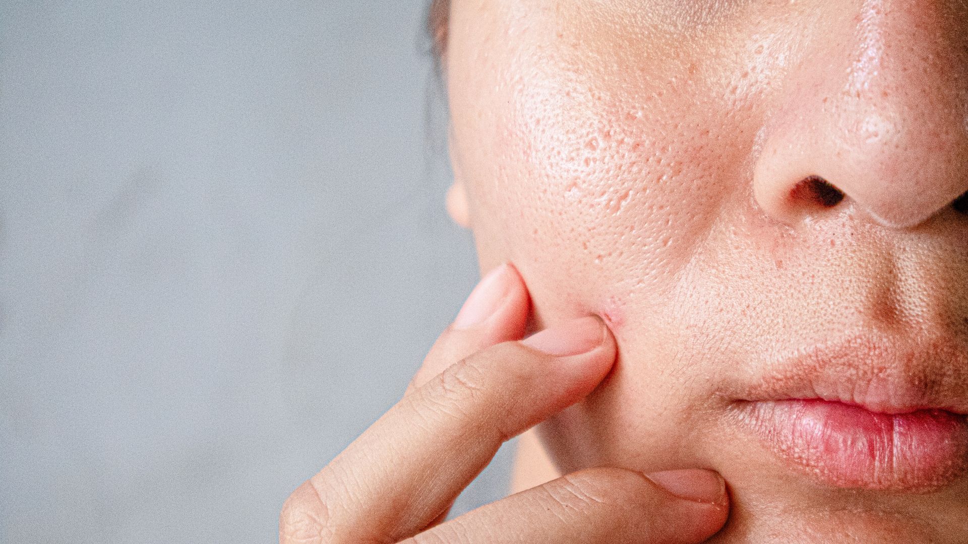 Person's face close-up, finger touching cheek. Skin shows pores, redness.