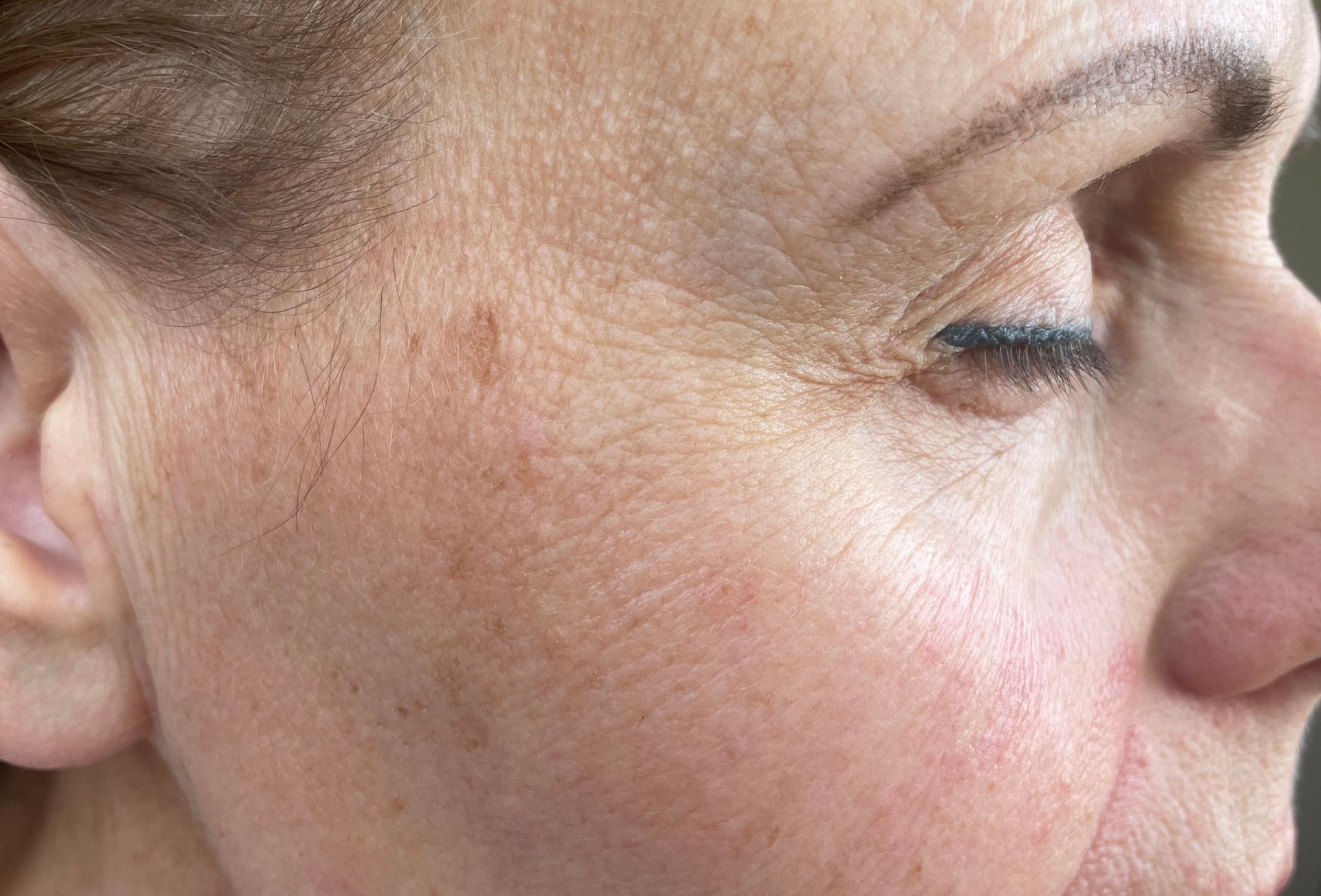 Close-up of a person's face; visible skin texture, fine lines, and a dark spot on the cheek.