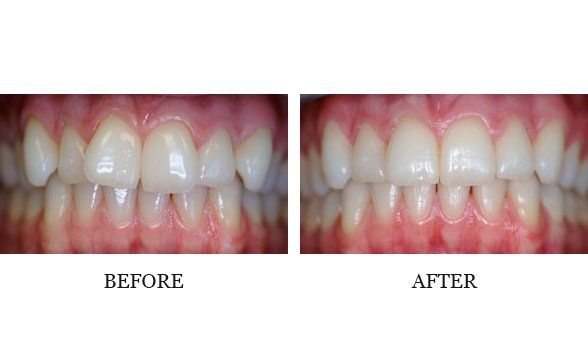 Invisalign case treated by Dr. Inaba