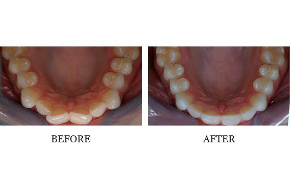 Invisalign case treated by Dr. Inaba