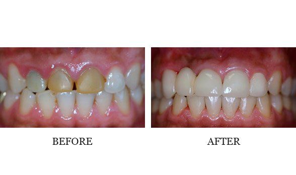 Anterior crown and bridge - Dr. Steve